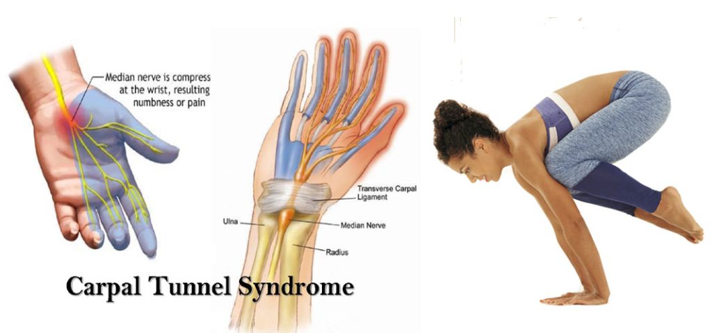 CARPEL-TUNNEL-SYNDROME
